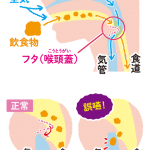 誤嚥性肺炎ってなに？